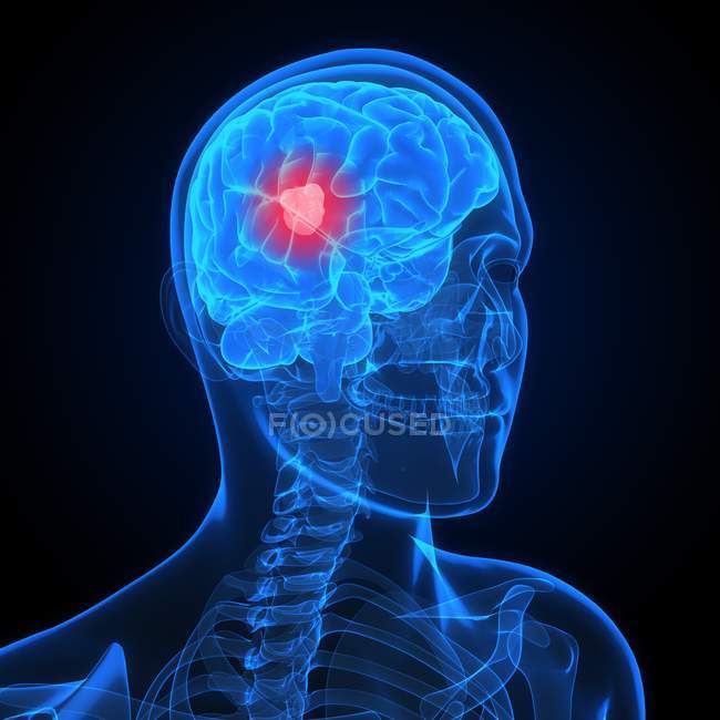 Visual render of Brain cancer — Stock Photo