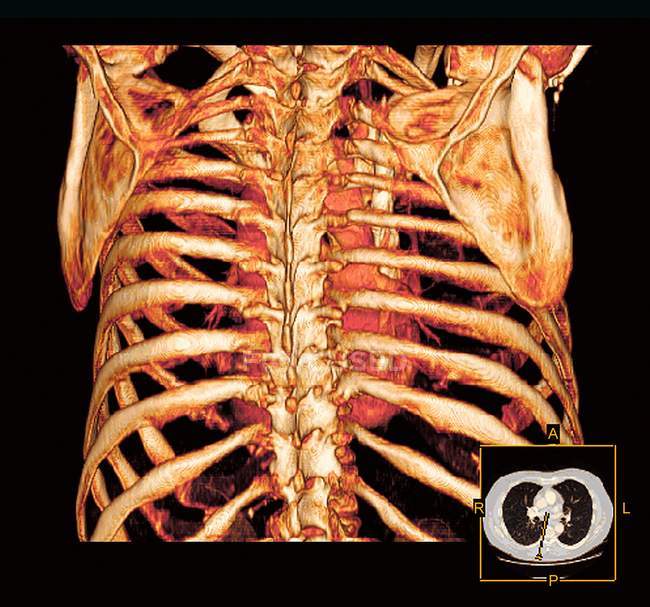 Tomografía computarizada tridimensional (TC) coloreada de una vista posterior de una caja torácica sana y corazón . - foto de stock