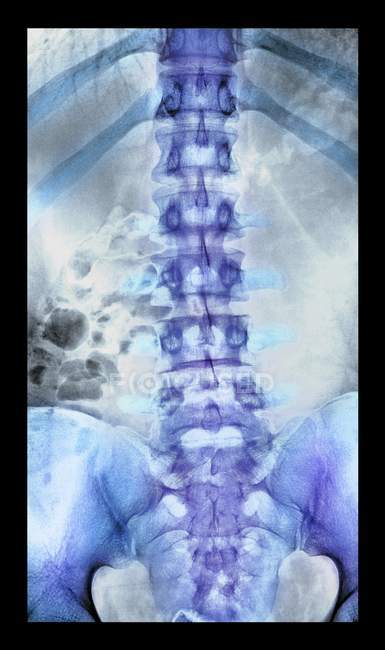 Columna vertebral normal y saludable - foto de stock