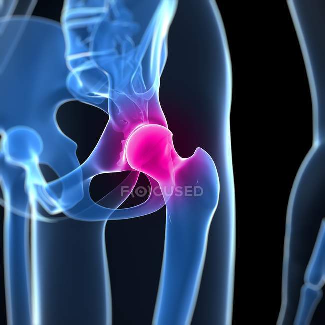 Ensazione dolorosa alle articolazioni dell'anca — Foto stock