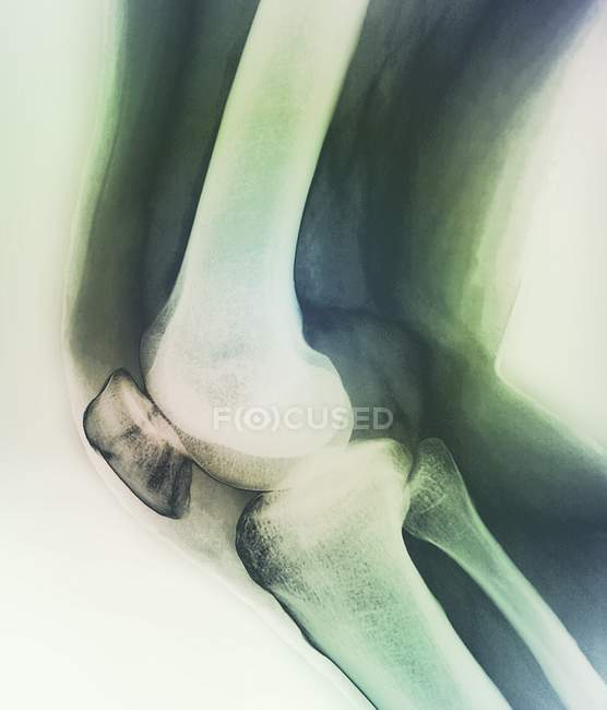 Radiografía de la rótula fracturada - foto de stock