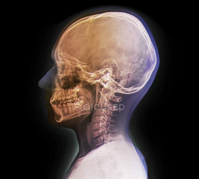 Normaler Kinderkopf. Röntgenbild des Kopfes eines 13-Jährigen. — Stockfoto