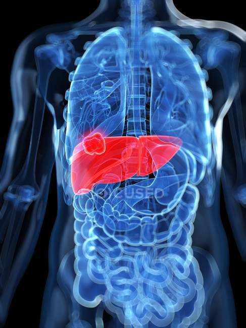 Visual rendering of liver cancer — Stock Photo