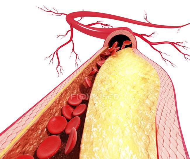 Placa de colesterol que conduce a la aterosclerosis - foto de stock