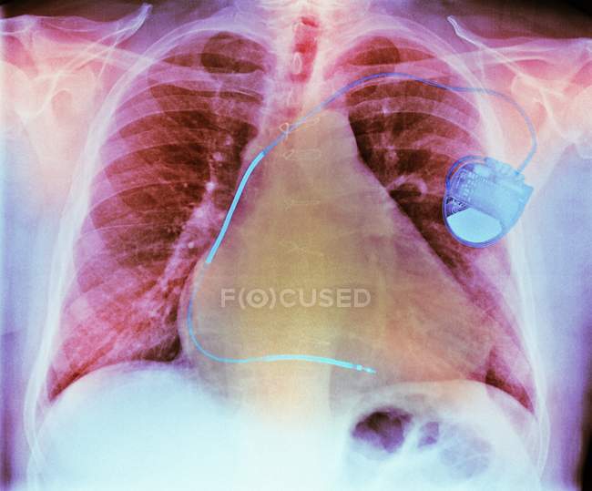 Кардиостимулятор при заболеваниях сердца — стоковое фото
