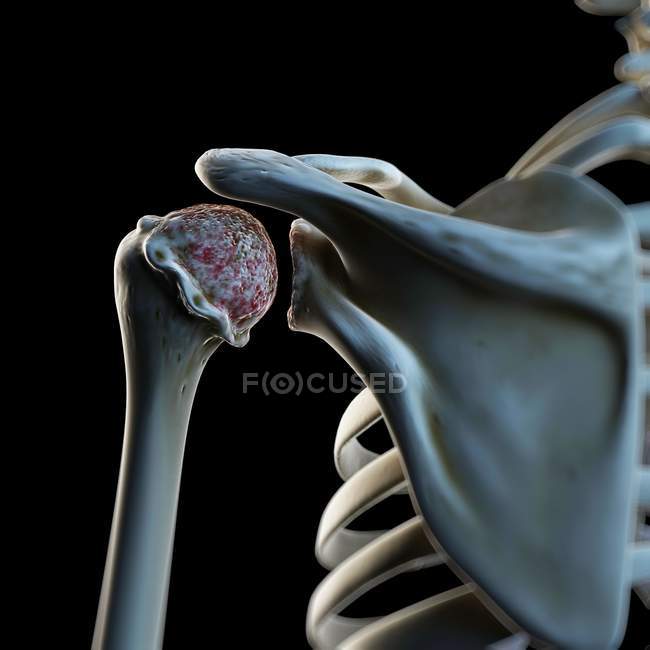 Visual rendering of arthritic shoulder — Stock Photo