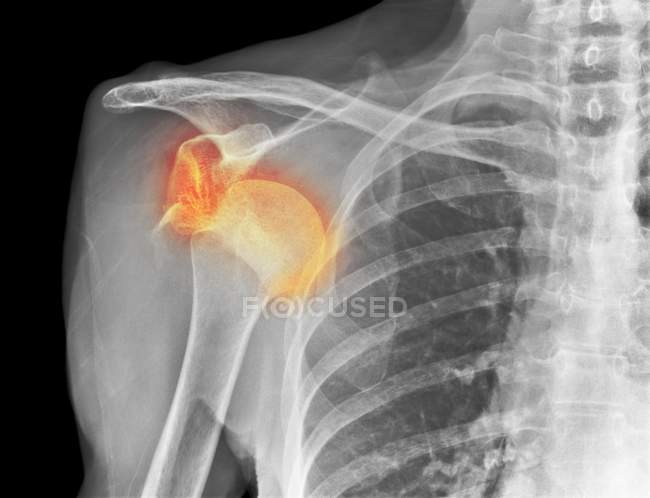 Рентген вывихнутого плеча — стоковое фото