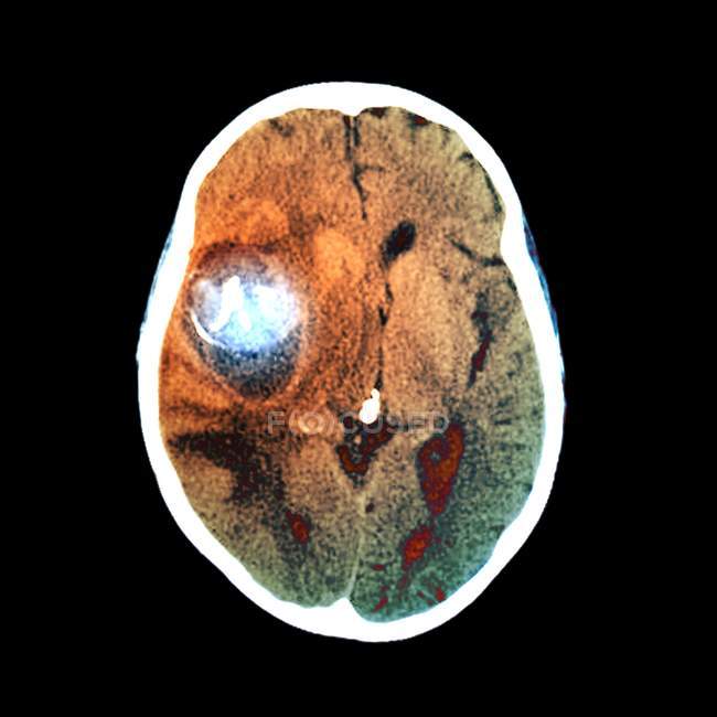 Brain with aneurysm in the middle cerebral artery — Stock Photo
