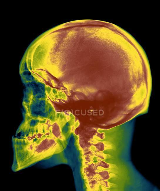 Radiographie du crâne d'un homme adulte — Photo de stock