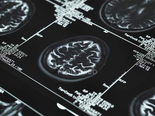 Series of MRI brain scans — Stock Photo