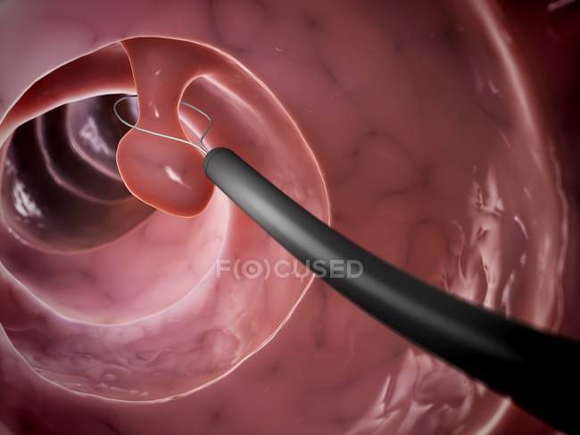 Removal of colon polyp — Stock Photo