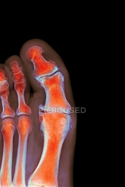 Degenerative foot deformation — Stock Photo