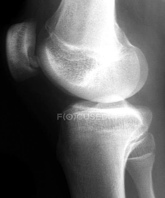 Osteochondritis dissekantiert das Knie — Stockfoto