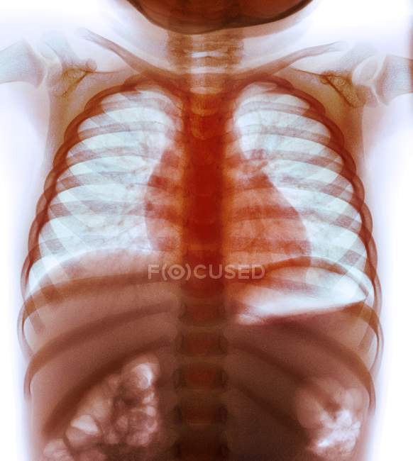 Swallowed coins in the oesophagus — Stock Photo