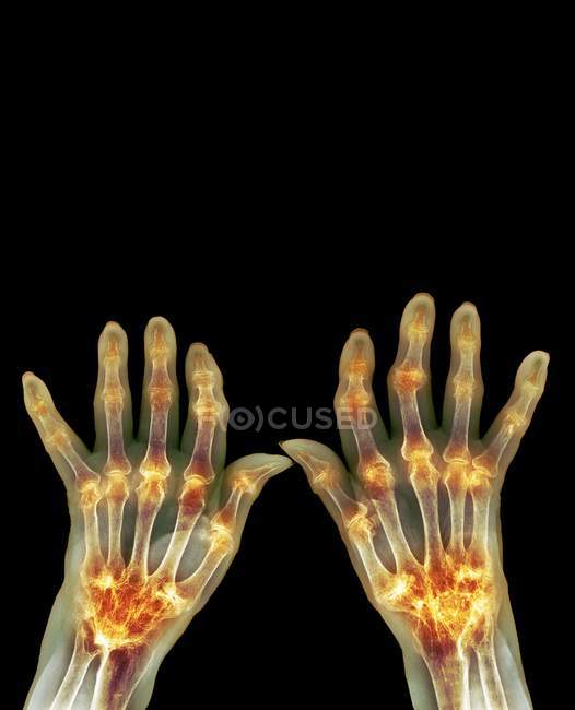 Ревматоидный артрит рук — стоковое фото