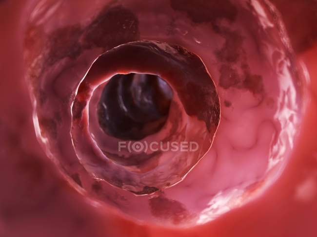 Inflamed colon pathology — Stock Photo