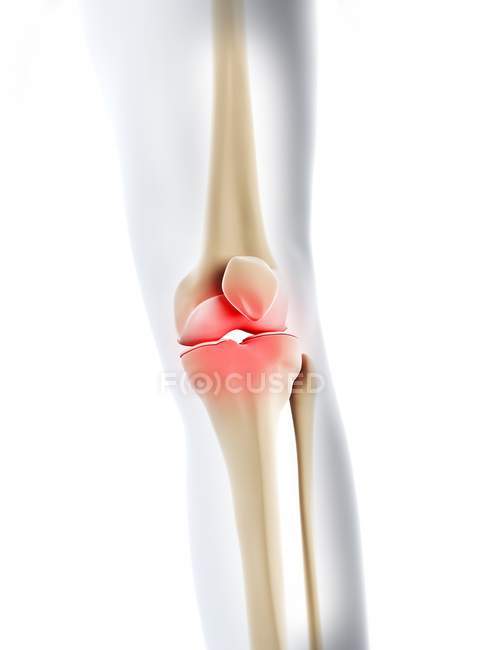 Articulación de la rodilla con foco localizado de inflamación - foto de stock