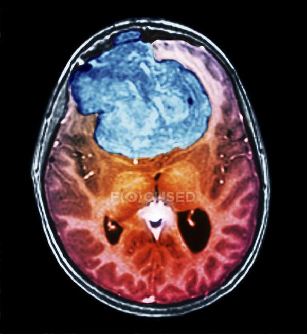 Tomografía computarizada (TC) coloreada del cerebro de un paciente de 25 años con meningioma (azul) ). - foto de stock