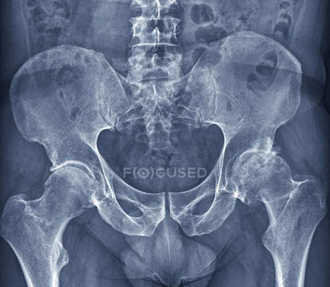 Osteoartritis de cadera - foto de stock
