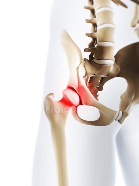 Focus of inflammation localized in hip joint — Stock Photo