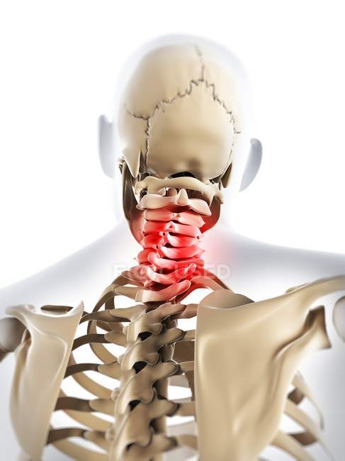 Schmerzen im Halswirbelsäulenbereich lokalisiert — Stockfoto
