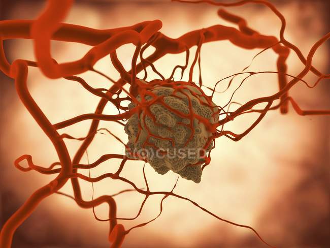 Tumor patológico e irrigação sanguínea — Fotografia de Stock