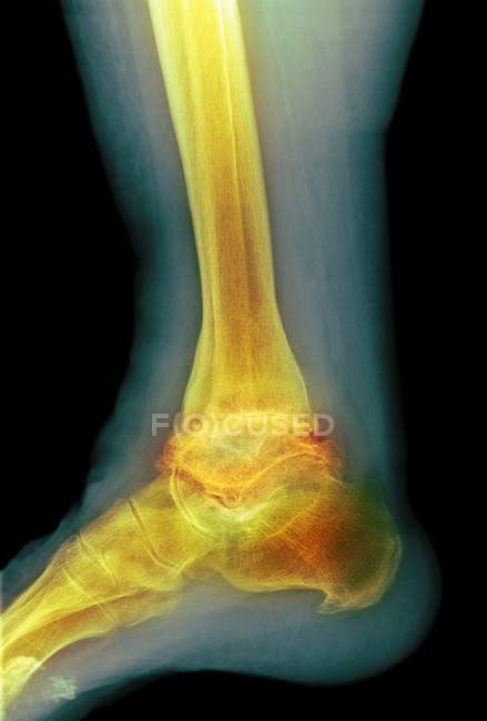 Osteoartrite grave della caviglia — Foto stock