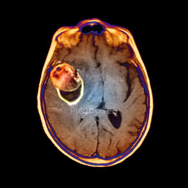 Cerebro con aneurisma en la arteria cerebral media - foto de stock