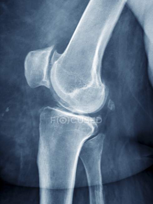 Rodilla del paciente obeso con artritis - foto de stock