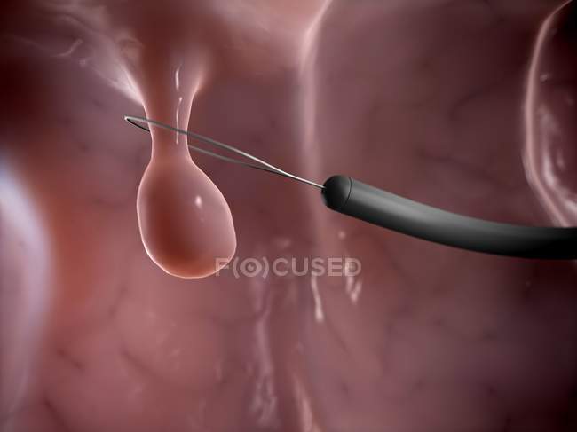Removal of colon polyp — Stock Photo