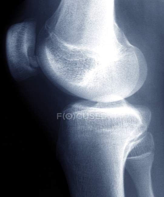 Остеохондриты коленного сустава — стоковое фото