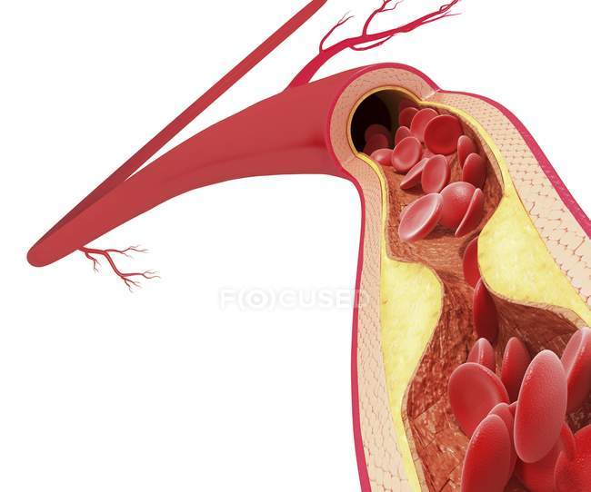 Cholesterol plaque leading to atherosclerosis — Stock Photo