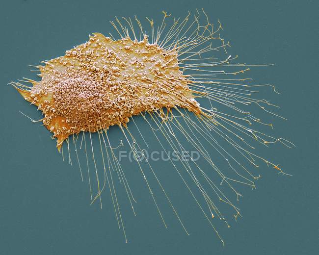 Остеосаркома ракова клітина — стокове фото