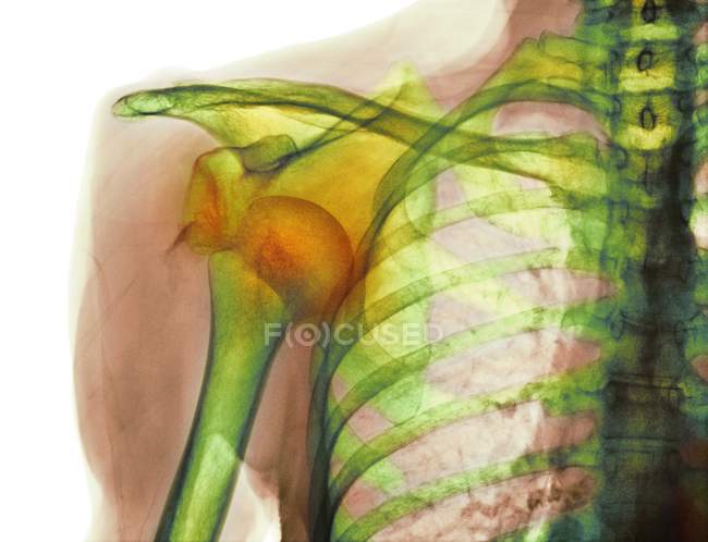 Raggi X della spalla lussata — Foto stock