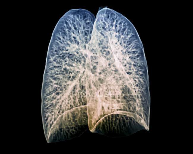 Tomografía computarizada (TC) 3D coloreada de los pulmones sanos de un paciente de 30 años
. - foto de stock
