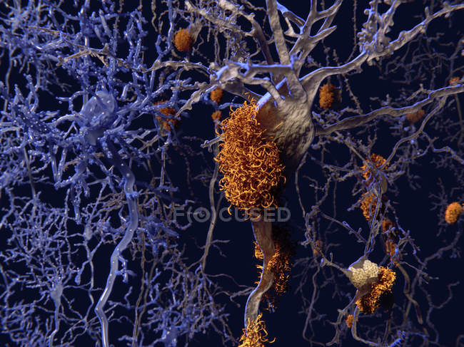 Células nerviosas afectadas por los alzheimers - foto de stock