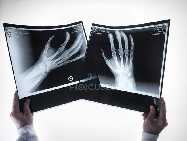 Immagine a raggi X delle ossa della mano — Foto stock