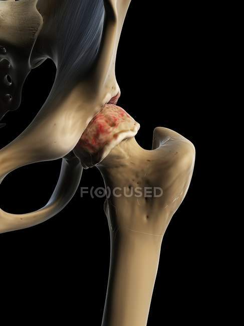 Arthritic inflammation of hip joint — Stock Photo
