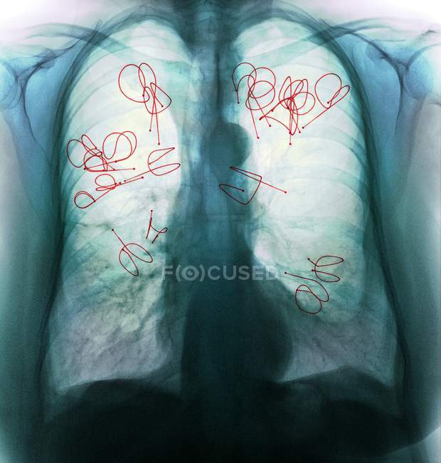 Эндобронхиальные клапаны, приспособленные для лечения туберкулеза — стоковое фото
