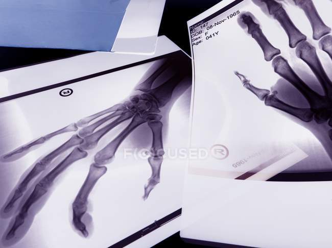 X-ray image of hand bones — Stock Photo