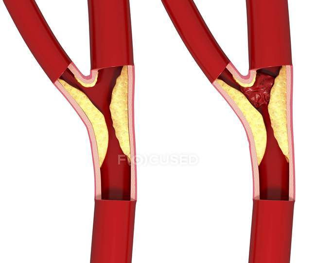 Атеросклероз і звужена артерія — стокове фото