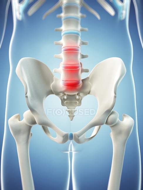 Pain localisation in lumbar section of spine — Stock Photo