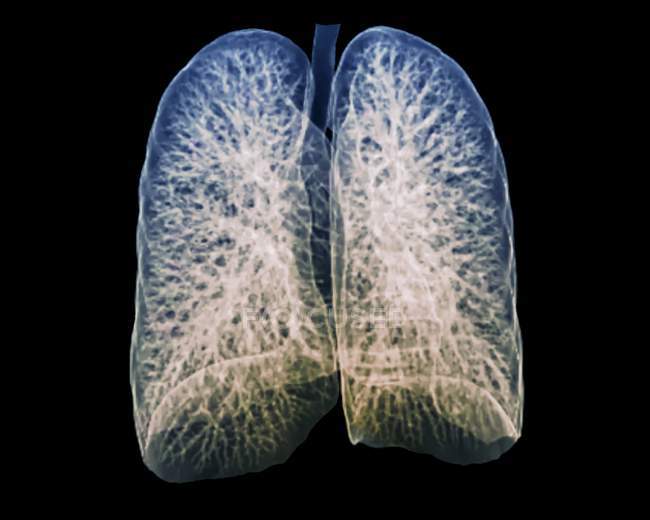Pulmones sanos de un paciente de 30 años - foto de stock