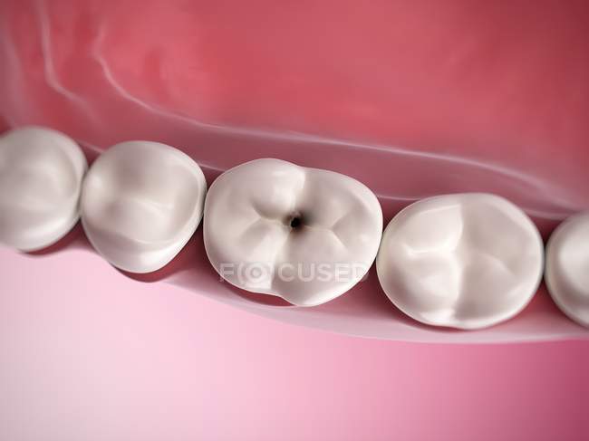 Caries dental humano - foto de stock