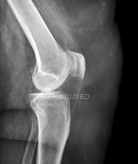 Rodilla del paciente obeso con artritis - foto de stock