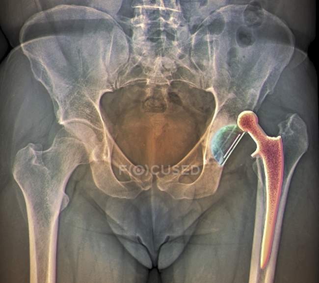 Substituição da anca deslocada — Fotografia de Stock