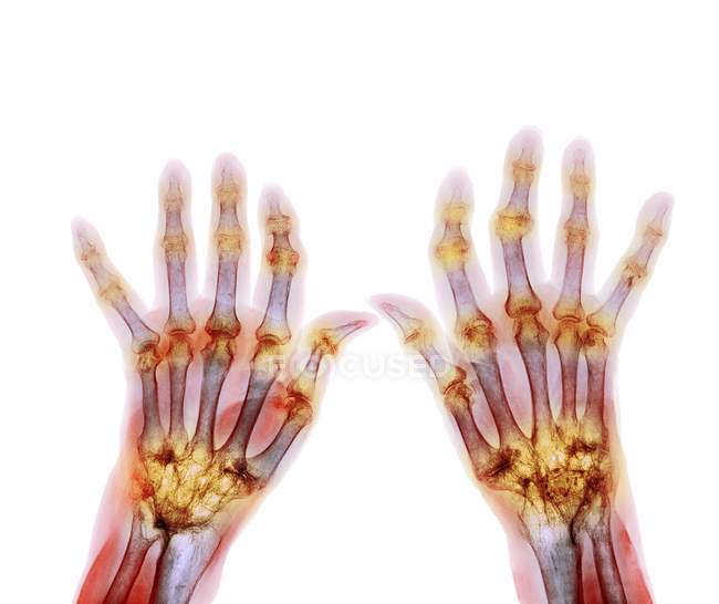 Artritis reumatoide de las manos - foto de stock