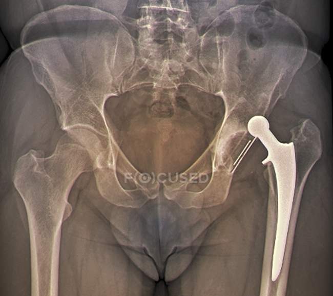 Dislocated hip replacement — Stock Photo