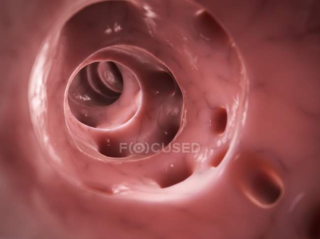 Diverticulitis del intestino grueso, ilustración por computadora
. - foto de stock