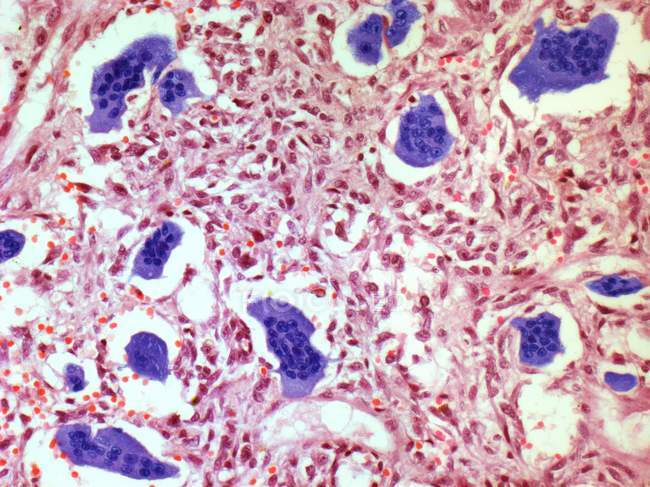 Tumor de células gigantes del hueso - foto de stock